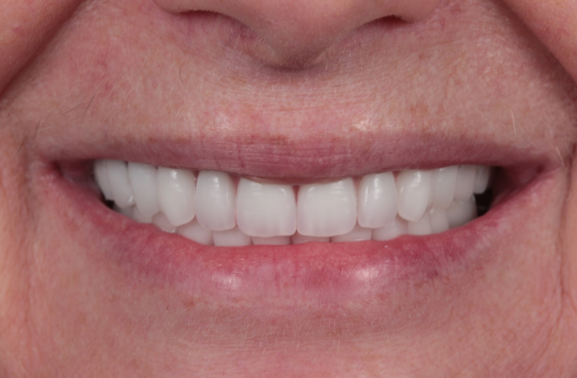 metamorfoza allon4 1.