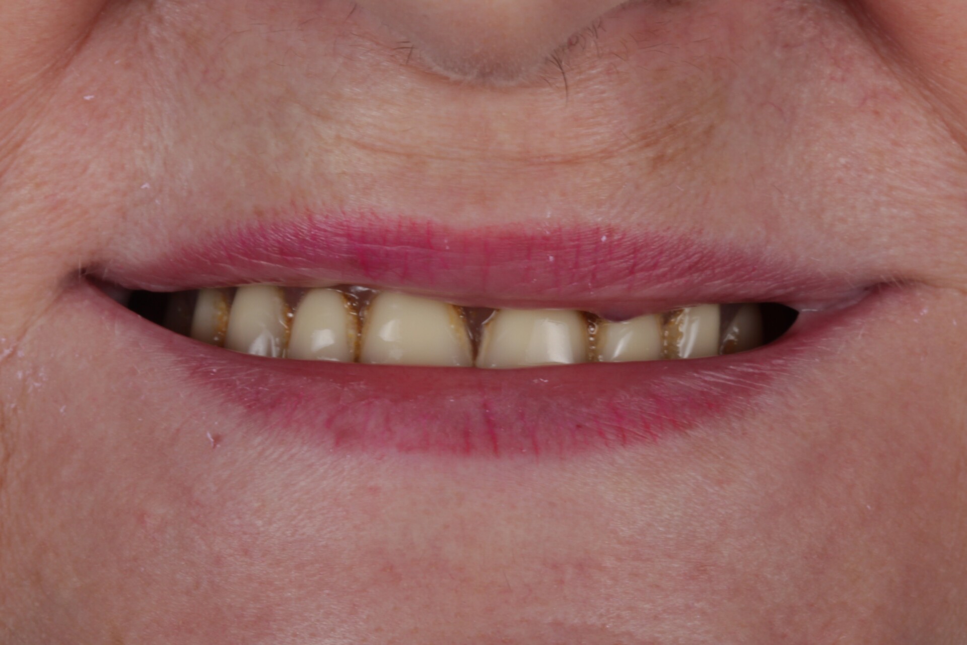 metamorfoza allon4 2.