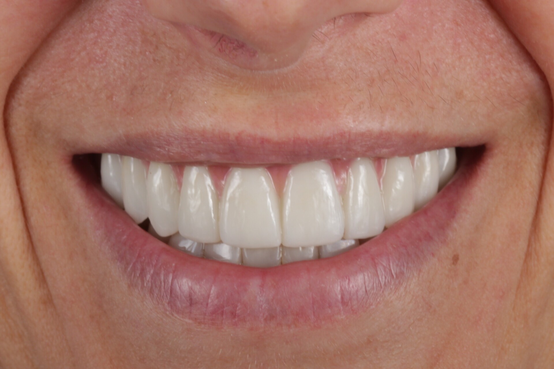 metamorfoza allon4 3.