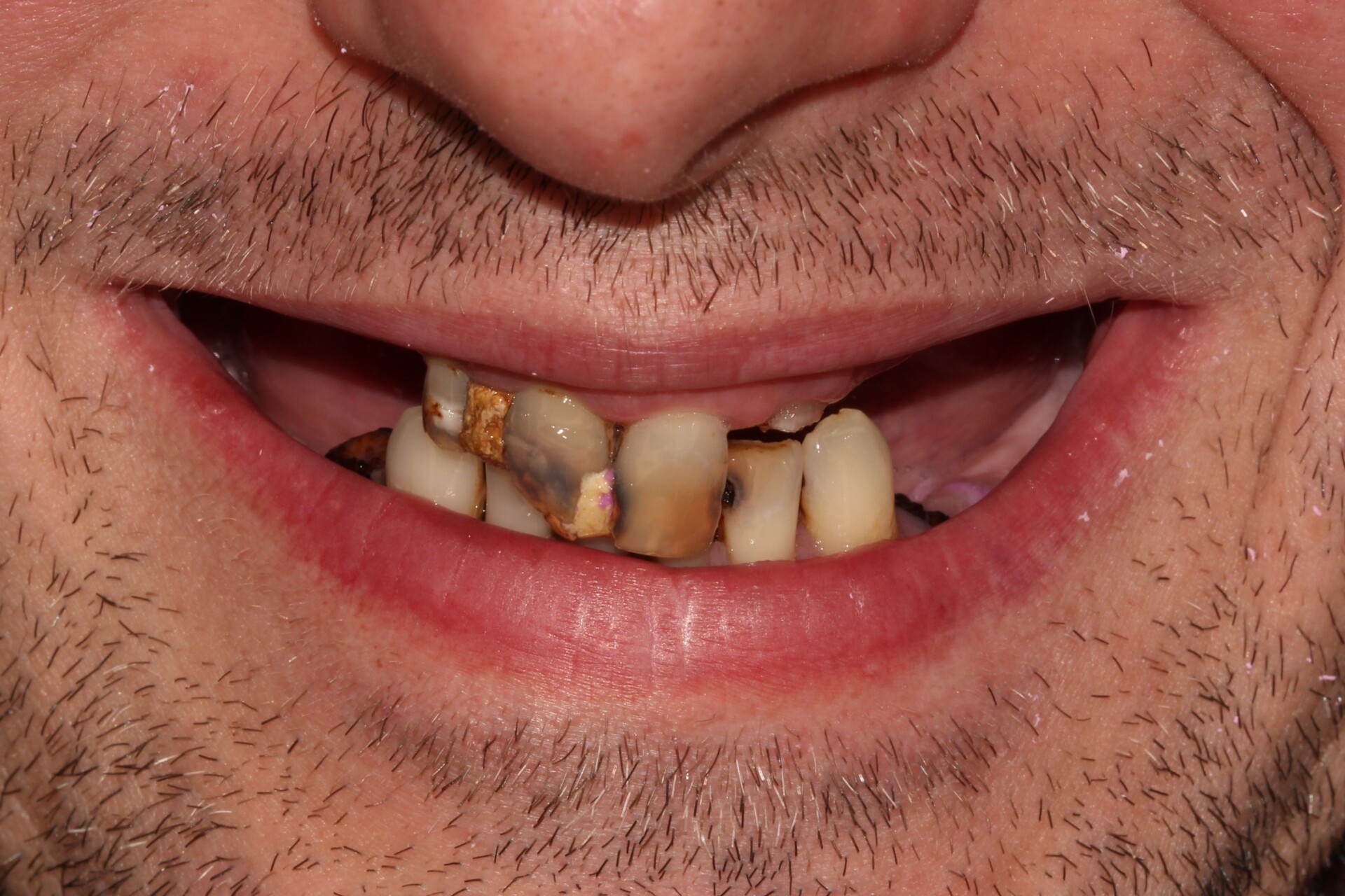 pelnolukowa odbudowa na implantach 2