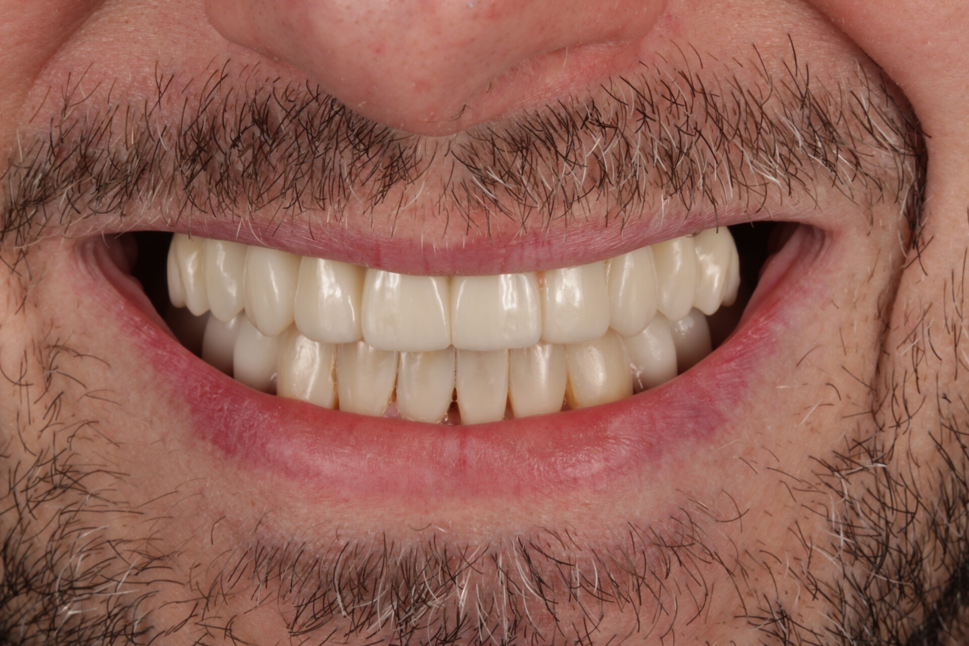 pelnolukowa odbudowa na implantach